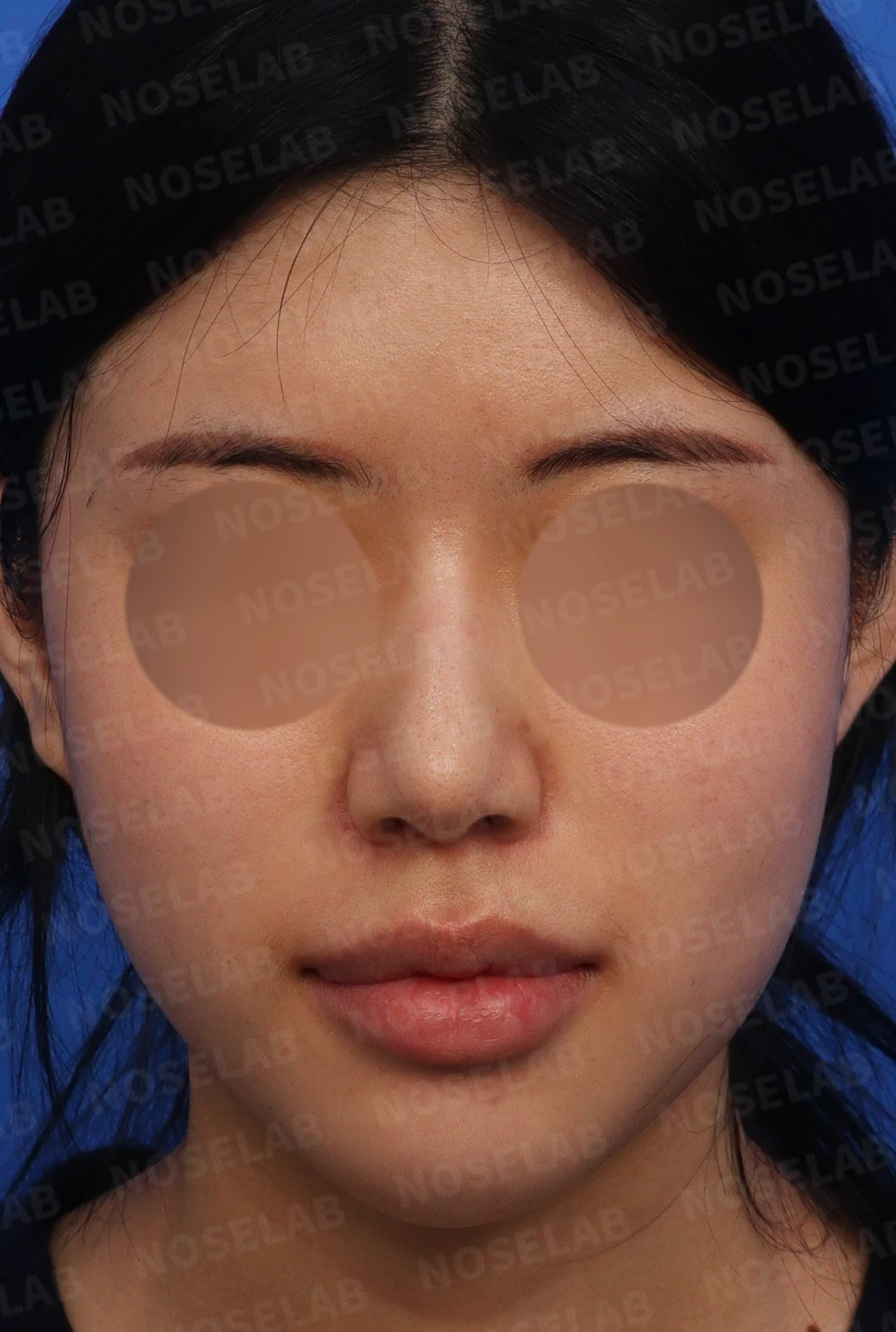 뭉툭한 코에서 화려한 코로의 변신: 맞춤형 코성형 여정 — 수술전 디자인 상담 정면, 측면, 비스듬한 측면