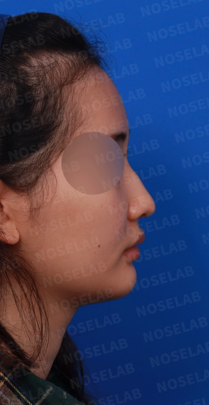 웃을 때만 화살코가 되는 이유와 코끝 연골 교정 방법 — 디자인 상담 우측 비스듬한 측면, 측면, 비공 사진입니다.