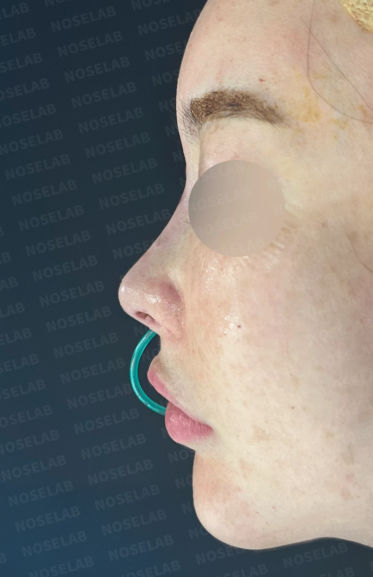 제거했다던 주사 이물질이 남는 이유와 들린 코끝 교정 방법 — 본문 사진 13