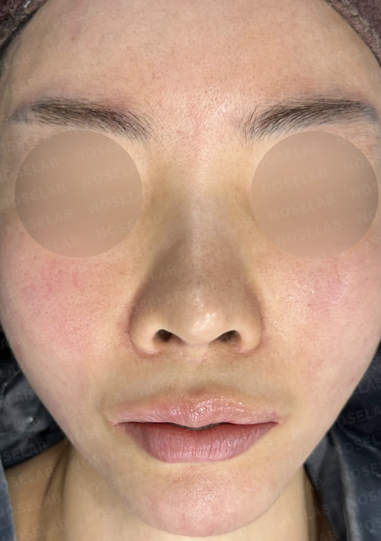 여러 차례 수술 뒤 코막힘이 남는 이유, 비중격과 비밸브 재건은 어떻게 하나 — 수술 전 / 수술 직후 0일 직후 사진은 부기가 있는 상태로 최종 결과와 다를 수 있습니다.