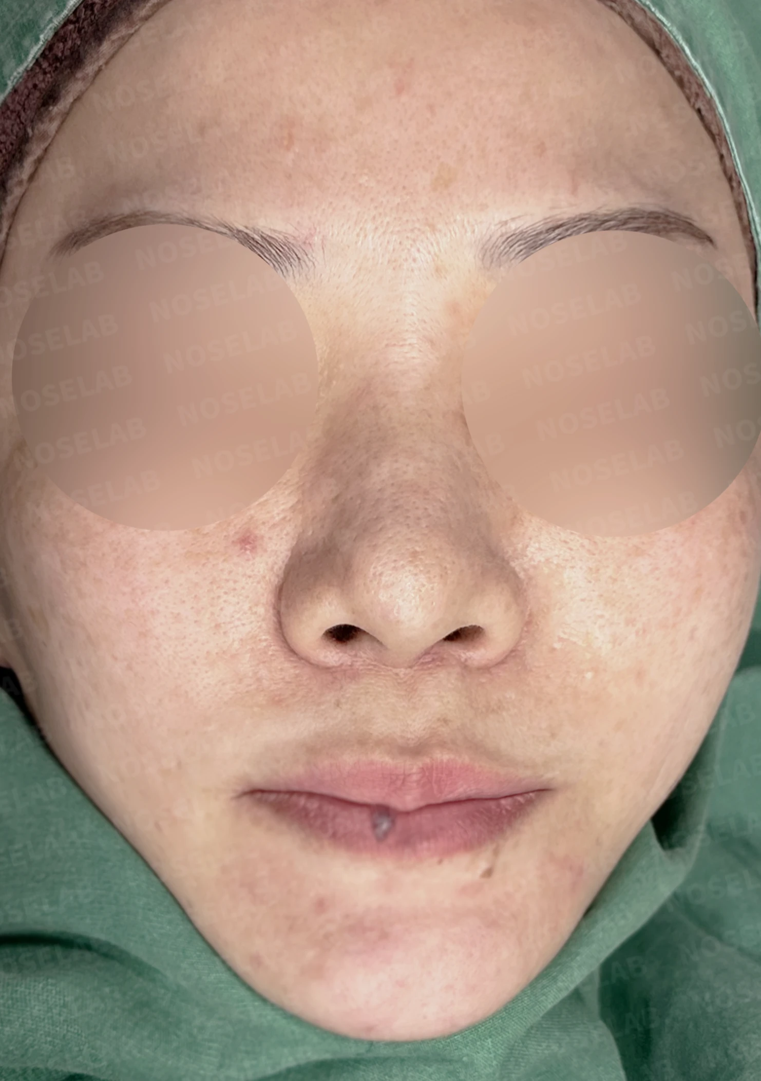 뭉툭하고 길게 처진 코가 중안면부를 길어 보이게 하는 이유, 석회화된 늑연골 재건 방법 — 수술 전 / 수술 직후 0일 직후 사진은 부기가 있는 상태로 최종 결과와 다를 수 있습니다.