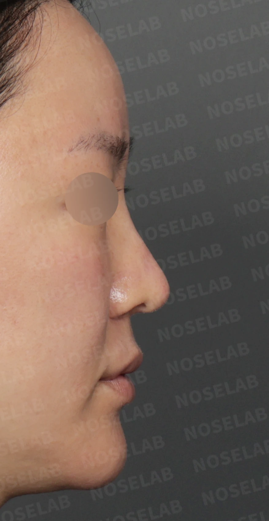 길고 처진 코 교정, 자가늑연골 비중격 재건과 콧대 보형물 교체로 완성한 코재수술 — 디자인 상담 우측 측면 , 비스듬한 측면 , 비공 사진 입니다.