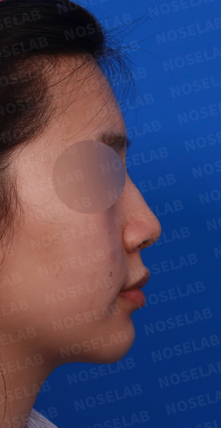 복코가 잘 교정되지 않는 이유와 이물질 제거 후 재건 방법 — 디자인 상담 우측 측면 , 비스듬한 측면 , 비공 사진
