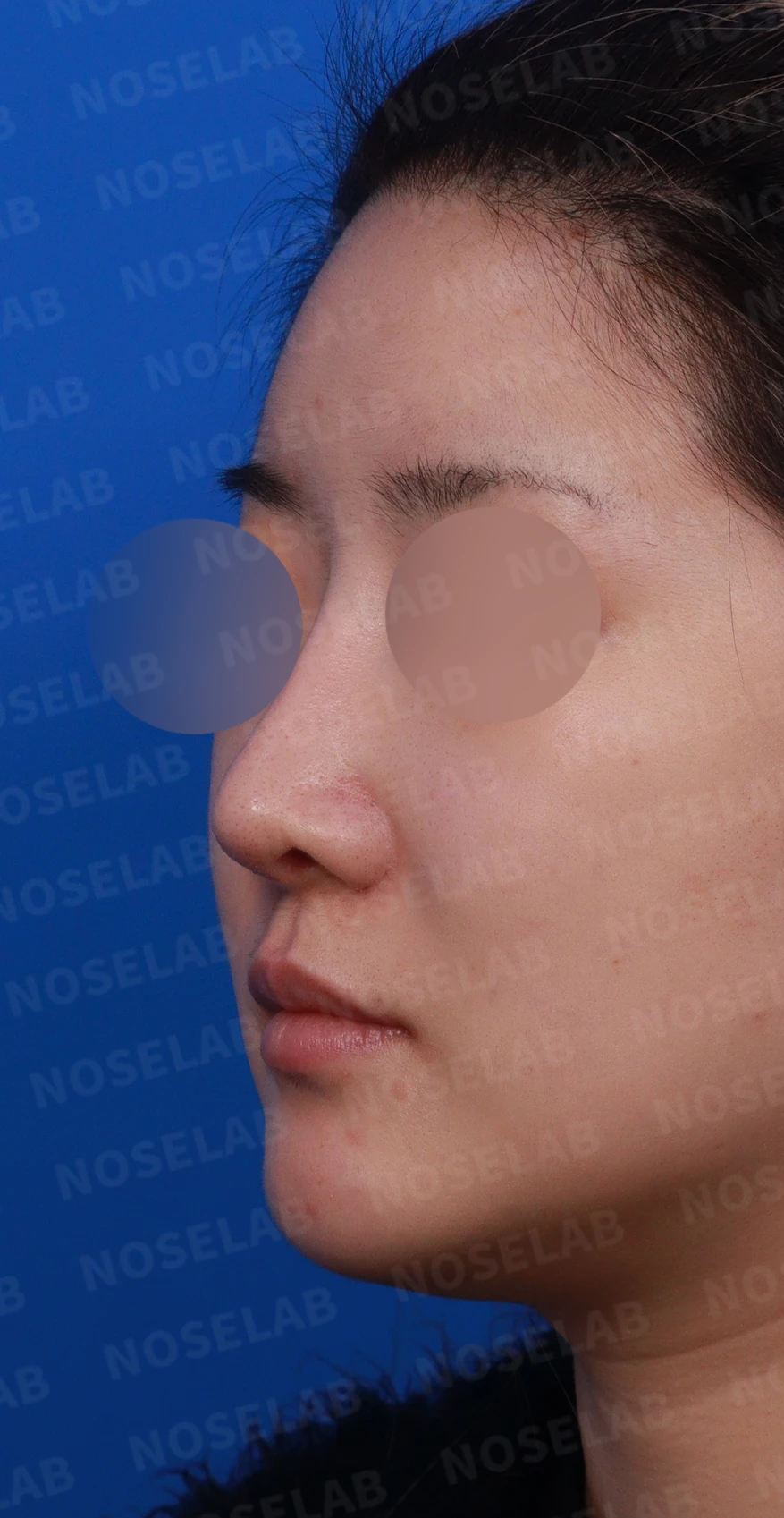 코재수술 뒤 콧대가 붉어 보이는 이유와 재건 방법 — 디자인 상담 정면, 좌측 측면, 비스듬한 측면 사진