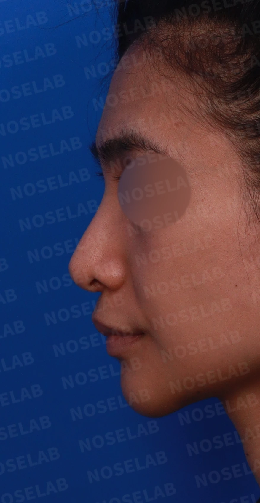 비주가 심하게 처지고 화살코가 되는 이유와 늑연골 재건 방법 — 디자인 상담 정면, 좌측 측면, 비스듬한 측면 사진