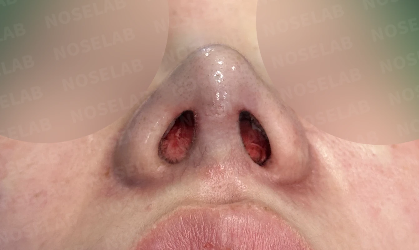 비주 함몰과 콧날개 변형, 자가늑연골을 이용한 코재수술로 자연스럽게 교정 — 직후 비공 사진입니다.