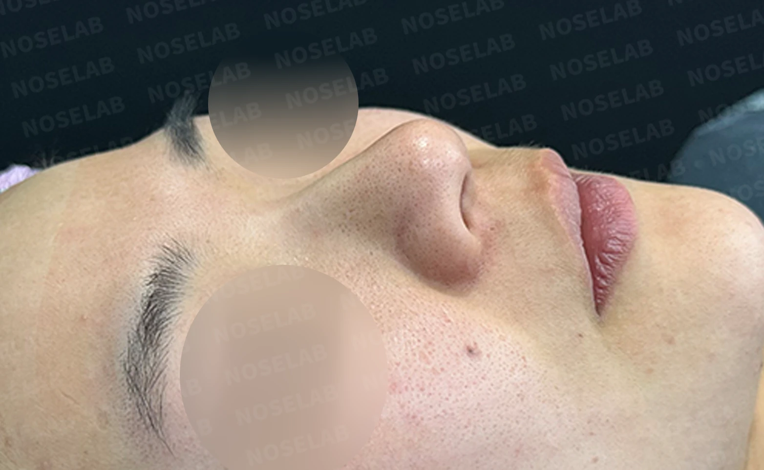 복코 수술은 어떻게 하나요? — 수술 전 / 수술 직후 0일 직후 사진은 부기가 있는 상태로 최종 결과와 다를 수 있습니다.