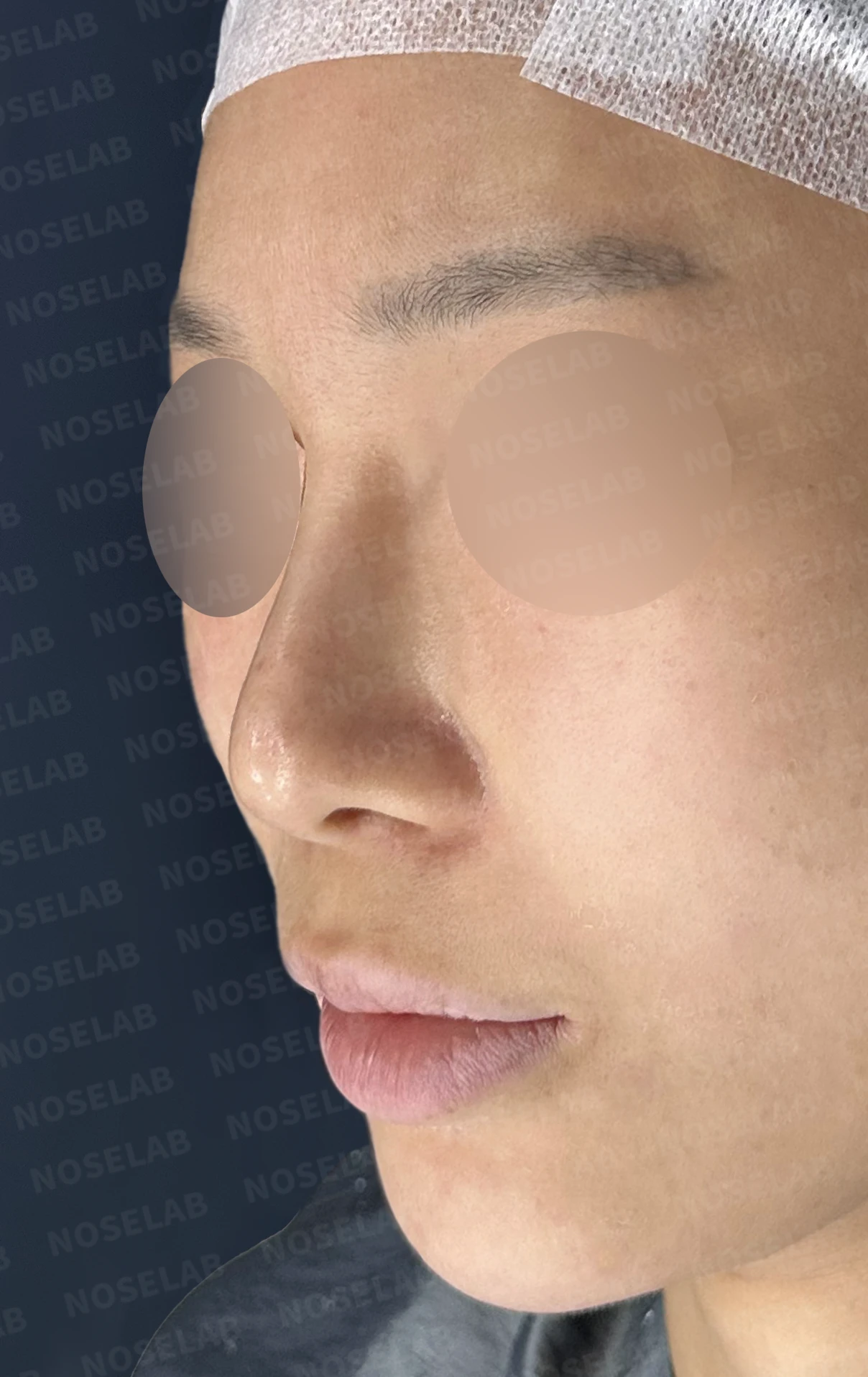 비중격 천공이 생기면 무엇이 문제이고 어떻게 재건하나 — 수술 전 / 수술 직후 0일 직후 사진은 부기가 있는 상태로 최종 결과와 다를 수 있습니다.