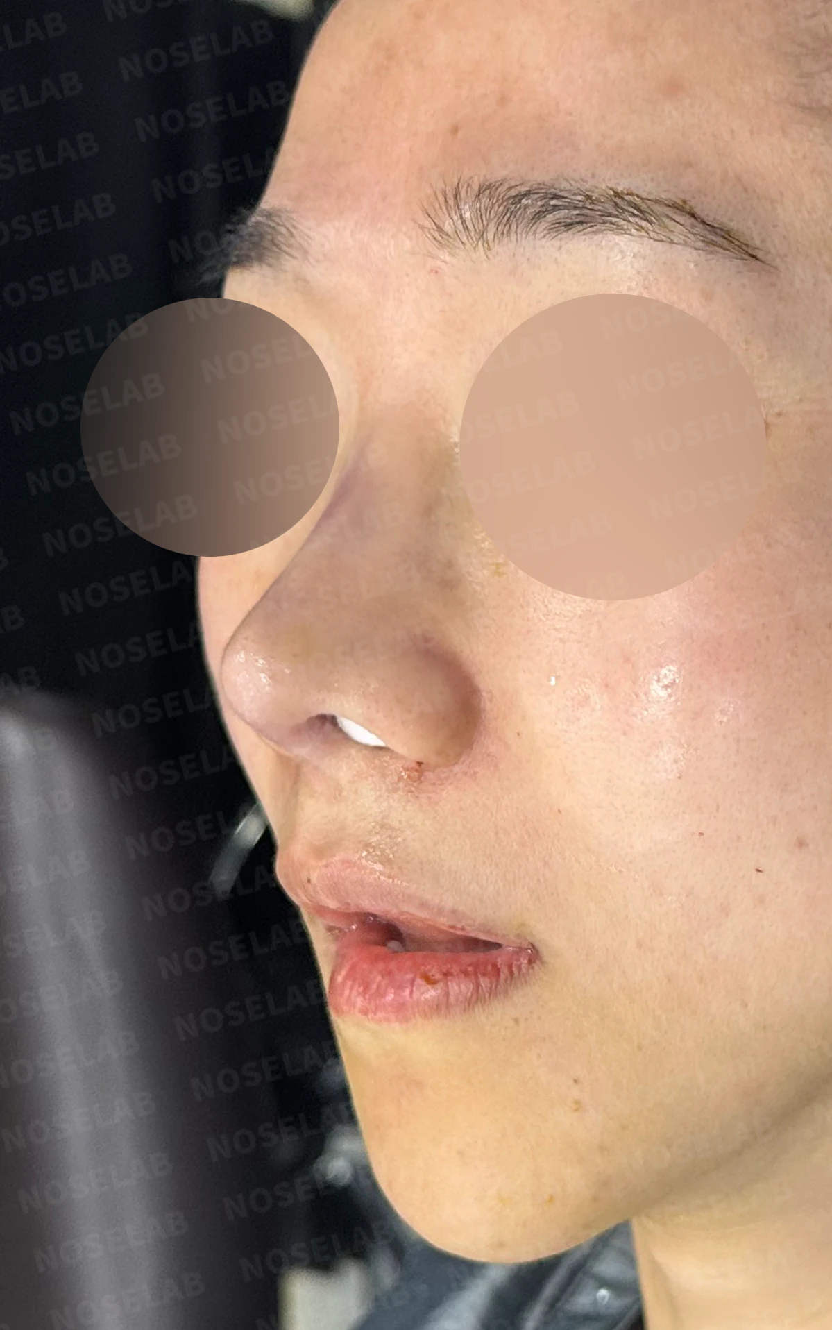 비중격 연골이 약해진 코, 보형물 없이 재건하는 방법 — 수술 전 / 수술 직후 0일 직후 사진은 부기가 있는 상태로 최종 결과와 다를 수 있습니다.