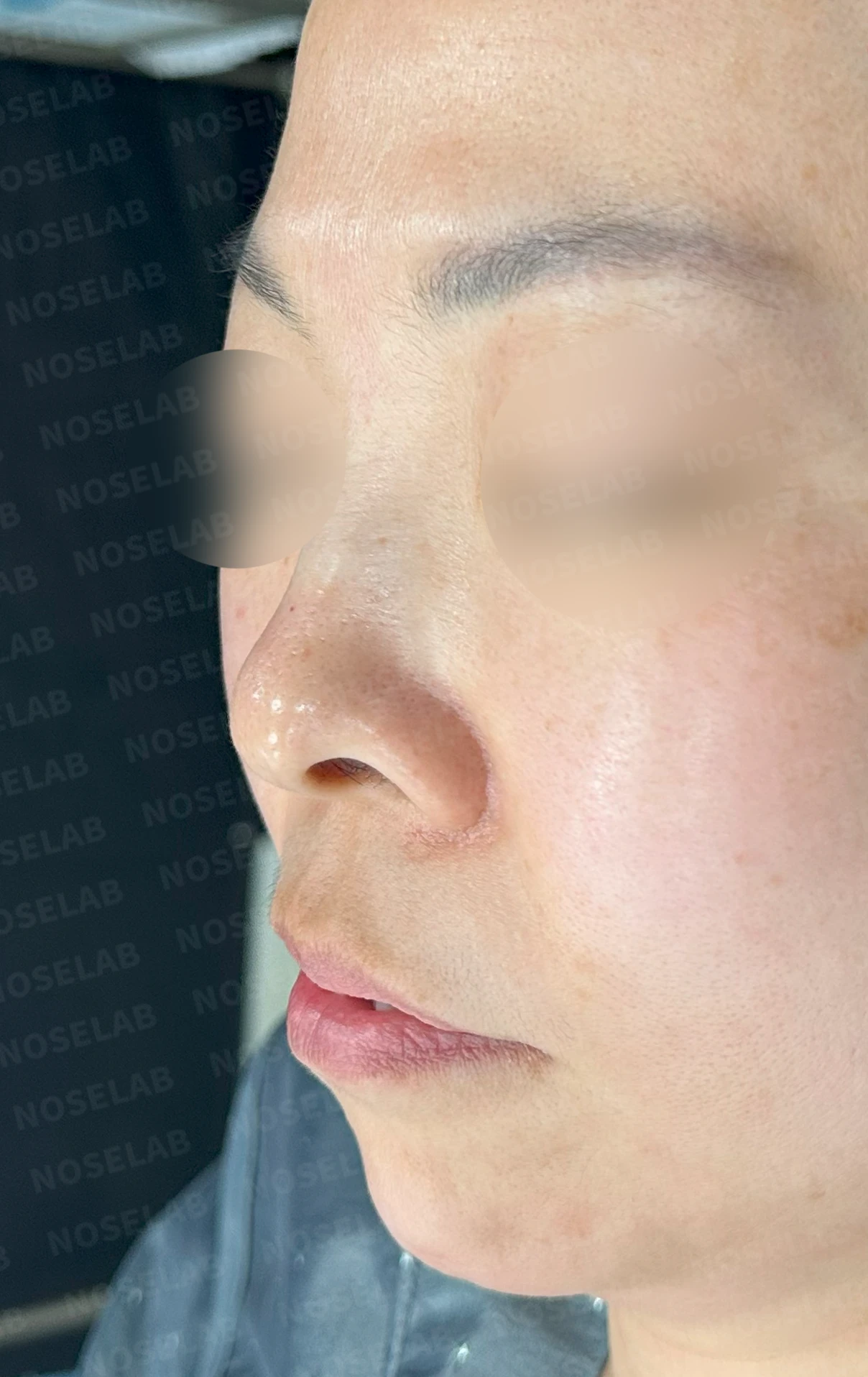 들창코에서 콧구멍이 많이 보이는 이유, 코끝 위치 교정은 어떻게 하나 — 수술 전 / 수술 직후 0일 직후 사진은 부기가 있는 상태로 최종 결과와 다를 수 있습니다.