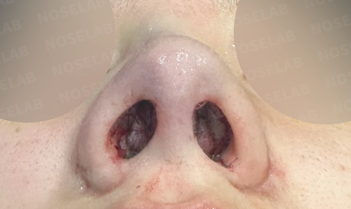 복코와 퍼진 코, 처진 코끝이 함께 오는 이유와 슬림한 라인을 만드는 방법 — 수술 직후 0일 비공 사진 직후 사진은 부기가 있는 상태로 최종 결과와 다를 수 있습니다.