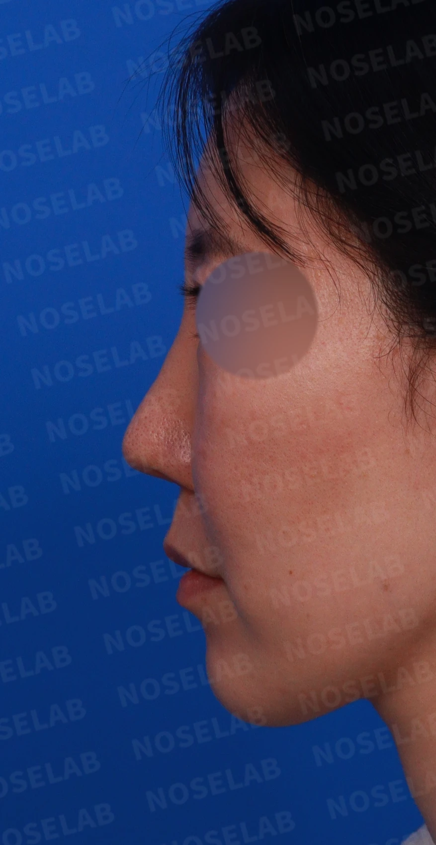 오래된 고어텍스 구축과 비중격 천공이 생기는 이유, 재건은 어떻게 하나 — 디자인 상담 정면, 좌측 측면, 비스듬한 측면 사진