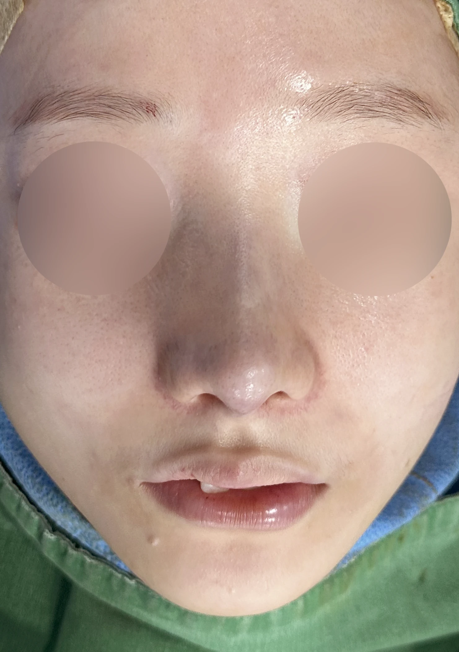 절골 부위가 과하게 깎이면 코가 왜 휘어 보이는가, 코뼈 복원과 코끝 재건 — 수술 직후 0일 정면, 비스듬한 측면, 측면 사진입니다 직후 사진은 부기가 있는 상태로 최종 결과와 다를 수 있습니다.