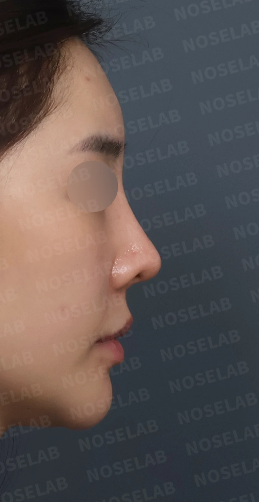 휘어진 코와 퍼진 코끝, 자가늑연골로 세련된 직반라인 완성한 코재수술 — 디자인 상담 우측 측면, 비스듬한 측면, 비공 사진입니다.