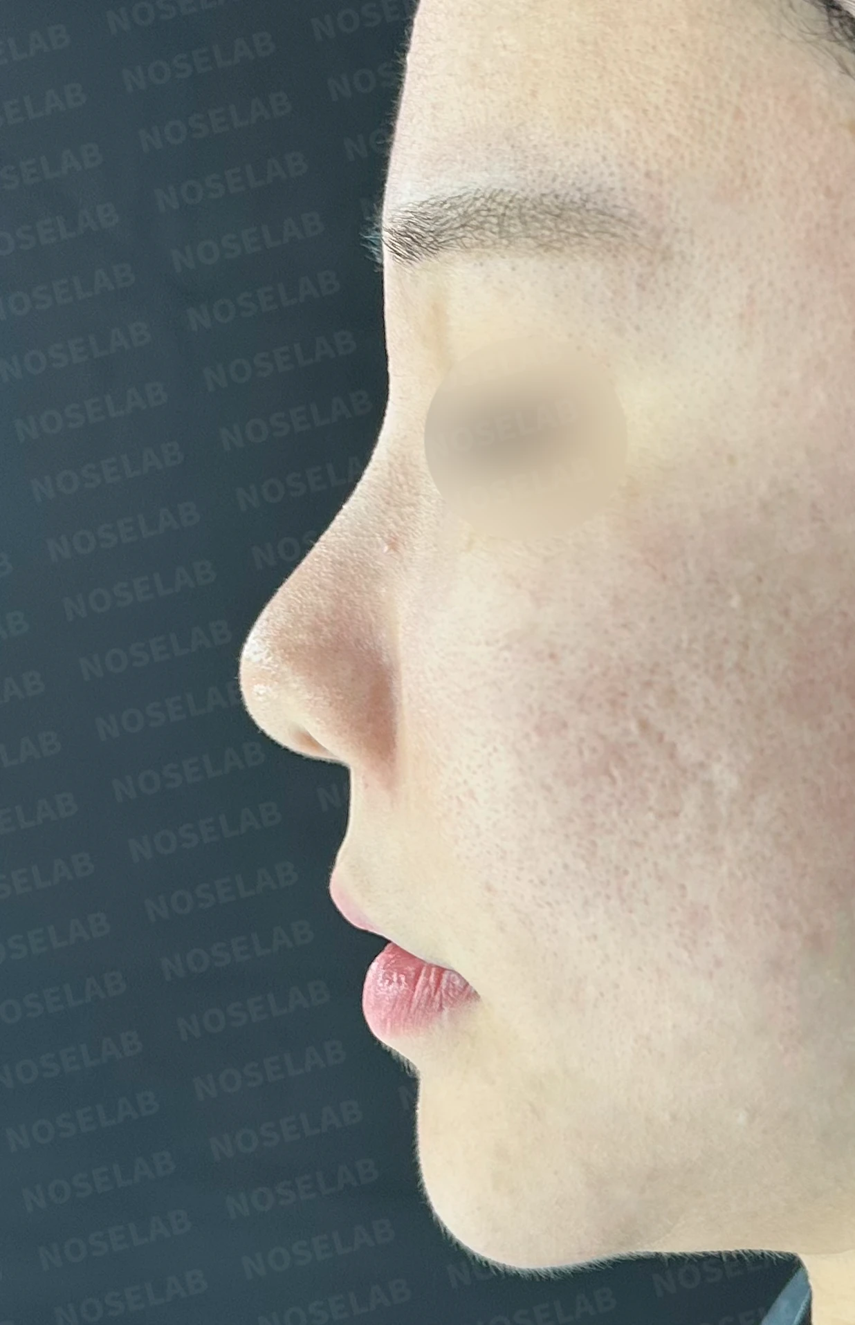 필러와 실 시술 뒤 코가 뭉툭해지는 이유, 이물질 제거와 코끝 교정 방법 — 수술 전 / 수술 직후 0일 직후 사진은 부기가 있는 상태로 최종 결과와 다를 수 있습니다.