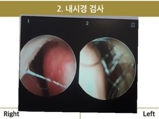 비공 비대칭, 퍼진코! 코재수술 사례 — 본문 사진 5