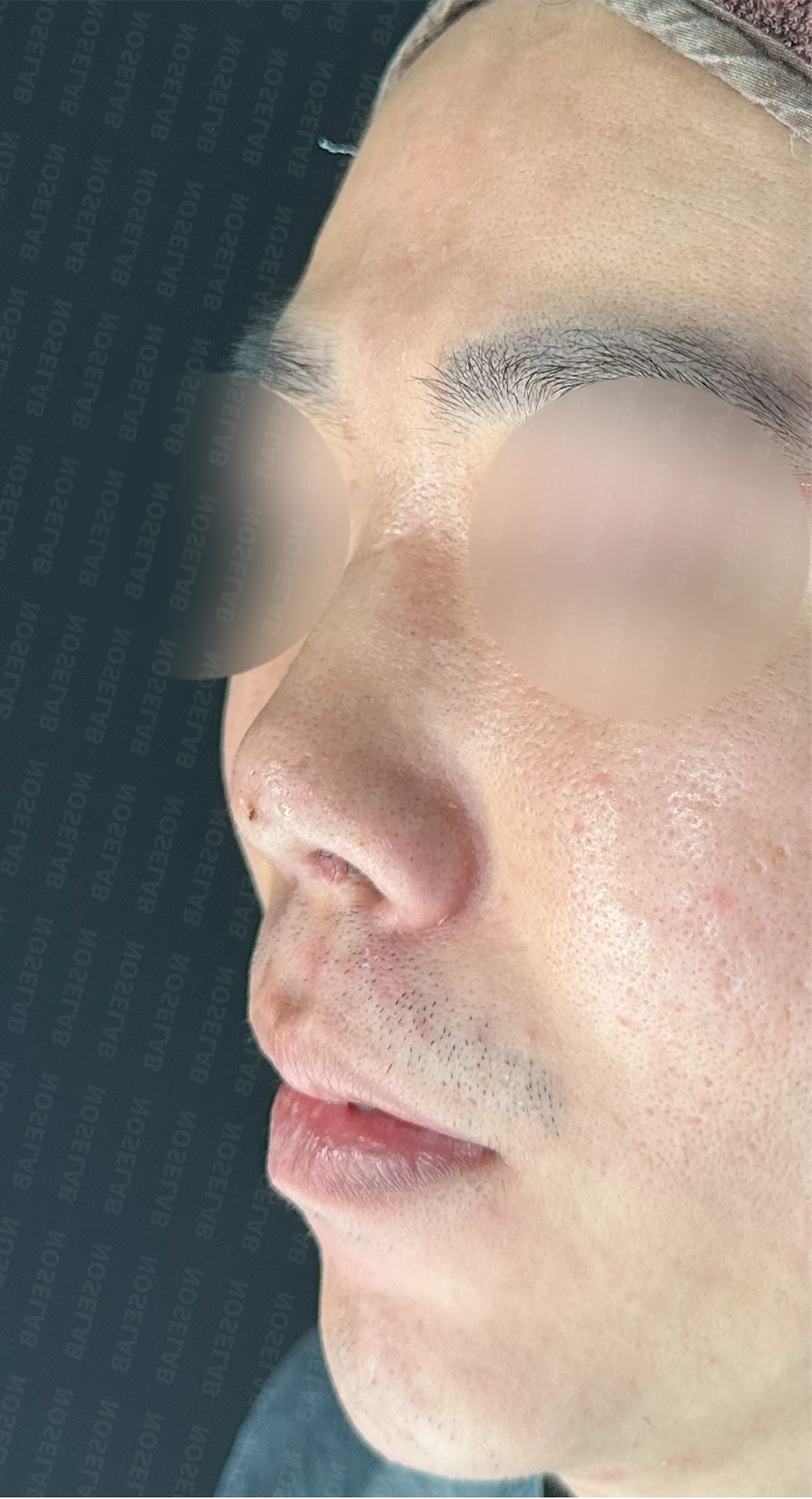 코끝 염증을 겪은 뒤 콧날개가 찝히고 코끝이 꺼지는 이유와 재건 방법 — 수술 전 / 수술 직후 0일 직후 사진은 부기가 있는 상태로 최종 결과와 다를 수 있습니다.