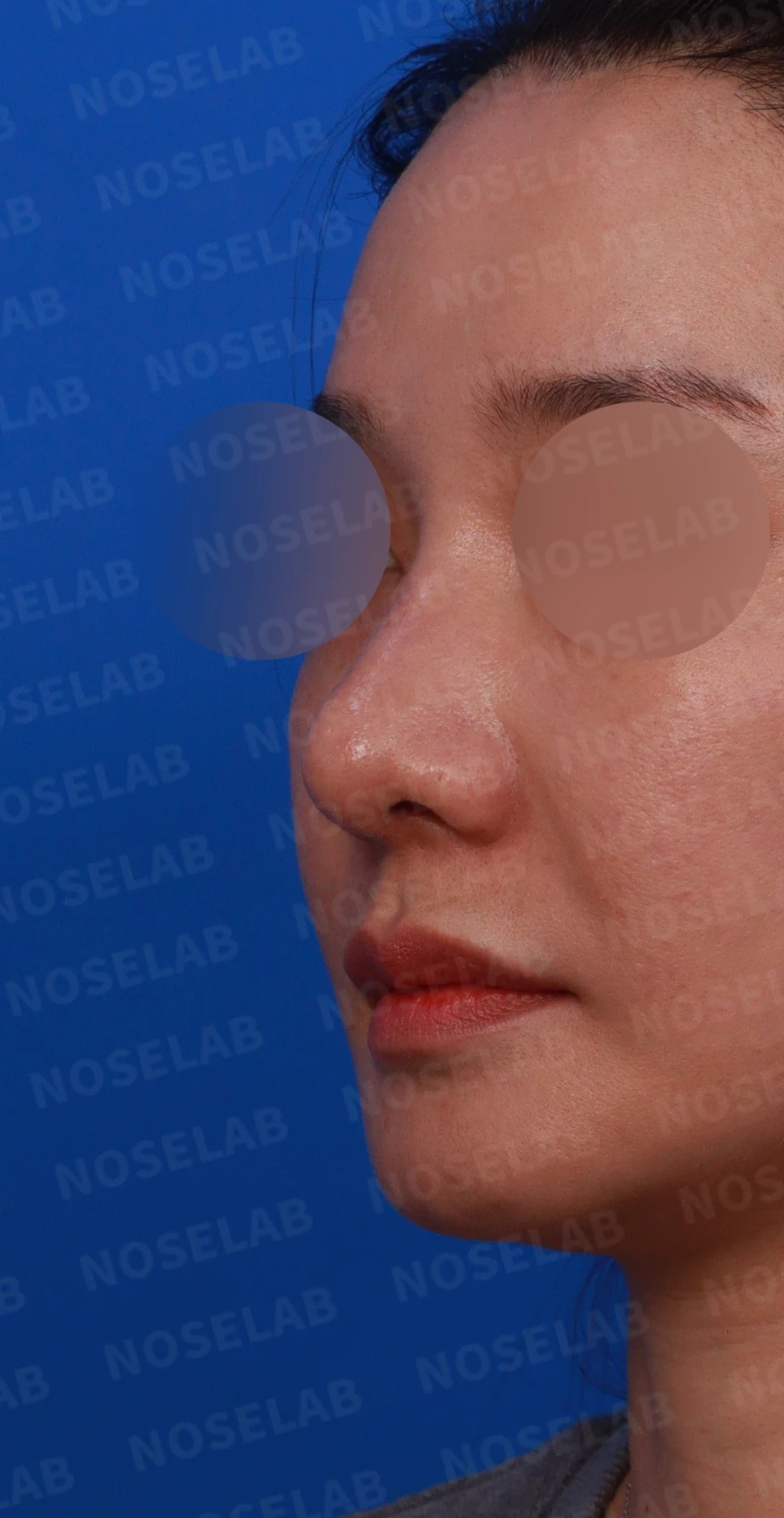 복코와 휜코의 구조를 살펴보는 교정 방법 — 디자인 상담 정면, 좌측 측면, 비스듬한 측면
