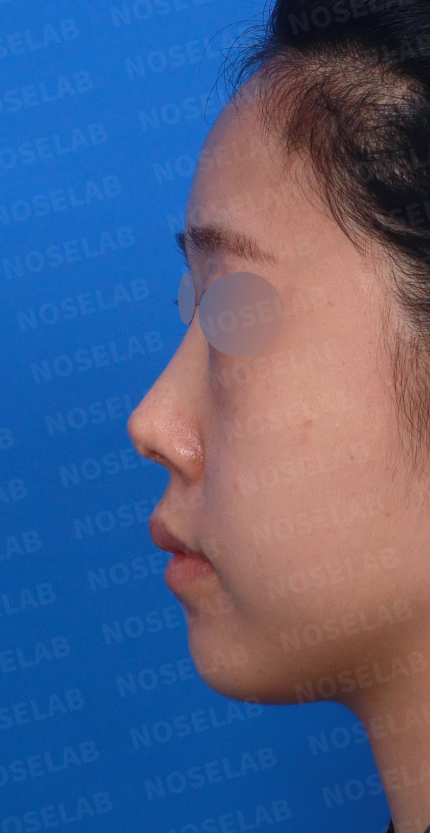 코끝 피부가 얇아져 연골이 비치는 이유, 피부 보강은 어떻게 하나 — 디자인 상담 정면, 좌측 측면, 비스듬한 측면 사진입니다.