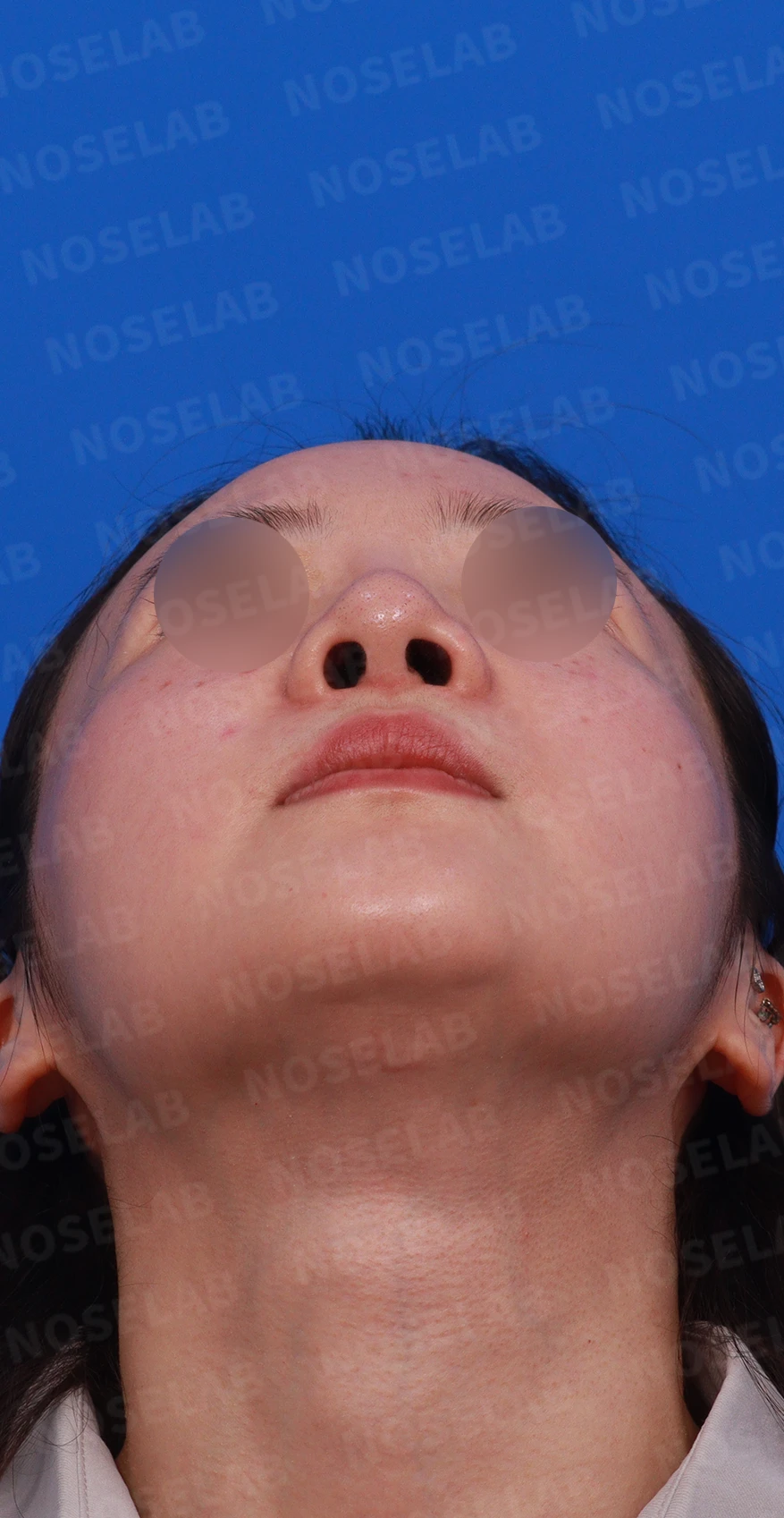 양악수술 뒤 코가 퍼져 보이고 코끝이 처지는 이유, 늑연골 재건 방법 — 디자인 상담 우측 측면 , 비스듬한 측면 , 비공 사진입니다.