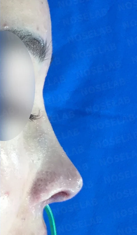 매부리코와 코끝의 비개방 교정 방법 — 본문 사진 2