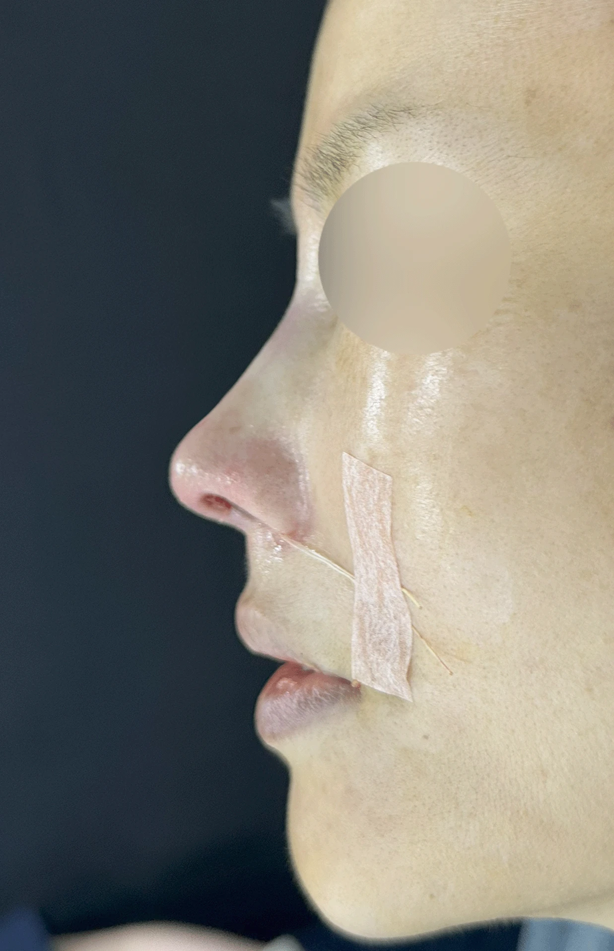 오래된 실리콘이 코끝에서 비쳐 보이는 이유와 제거·재건 방법 — 본문 사진 10