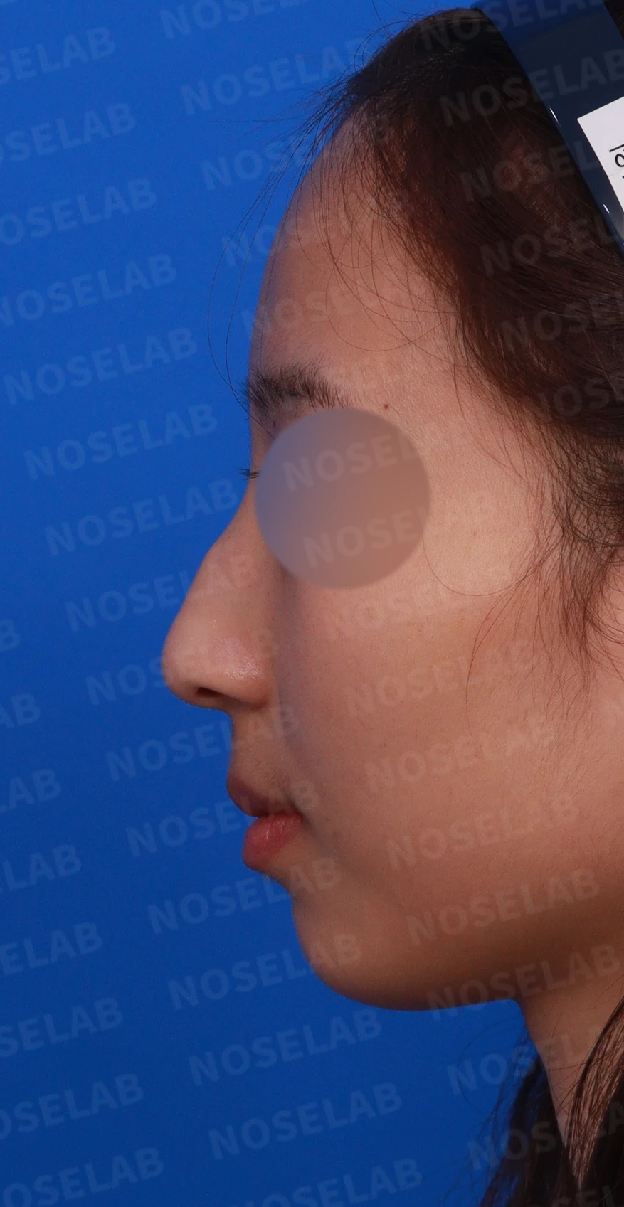 외상 뒤 심해진 매부리와 휜 코, 변화를 최소로 두는 교정 방법 — 디자인 상담 정면, 좌측 측면, 비스듬한 측면 사진