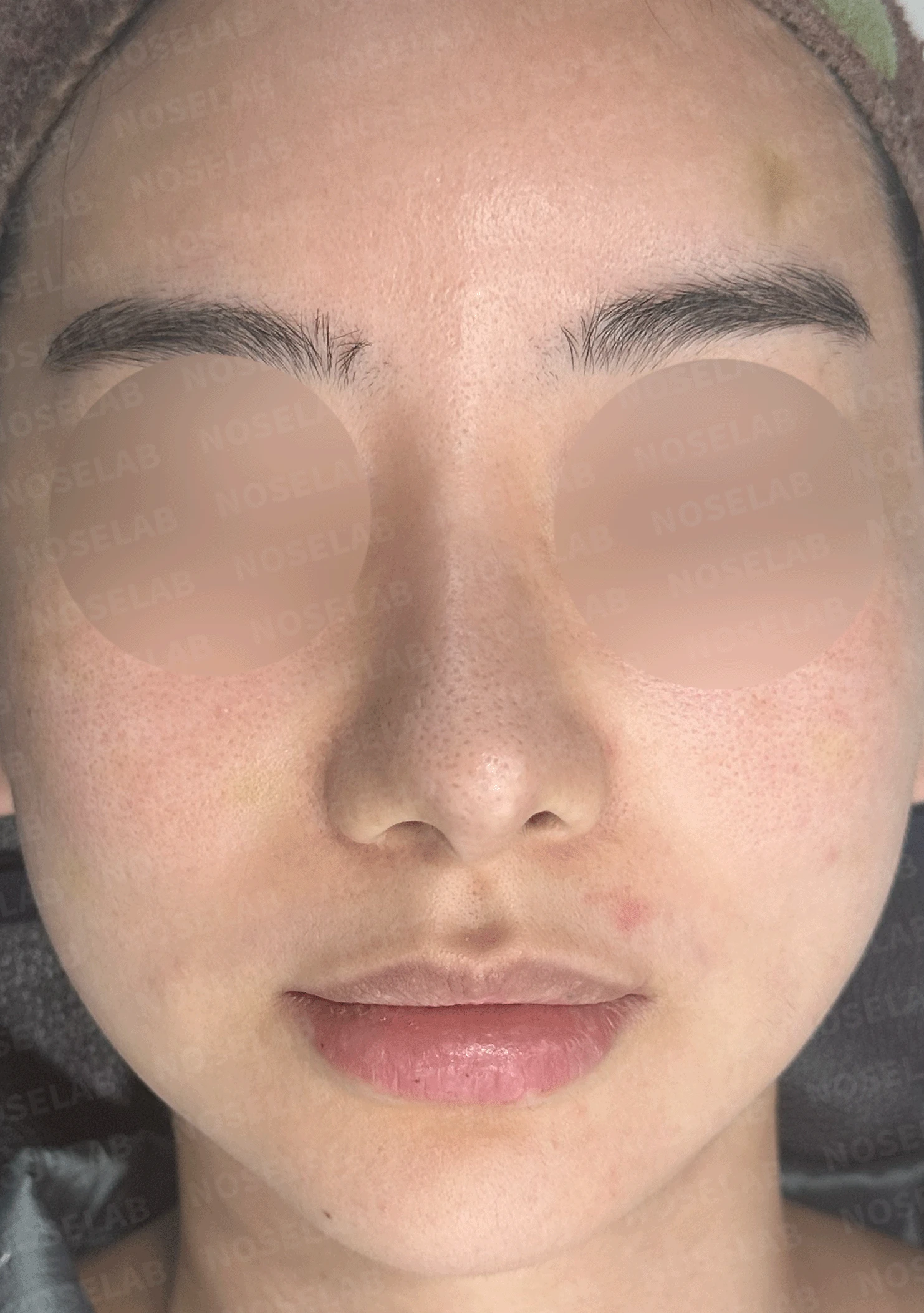 코가 과하게 높아져 부자연스러워 보이고 휘는 이유, 재건은 어떻게 하나 — 수술 전 / 수술 직후 0일 직후 사진은 부기가 있는 상태로 최종 결과와 다를 수 있습니다.