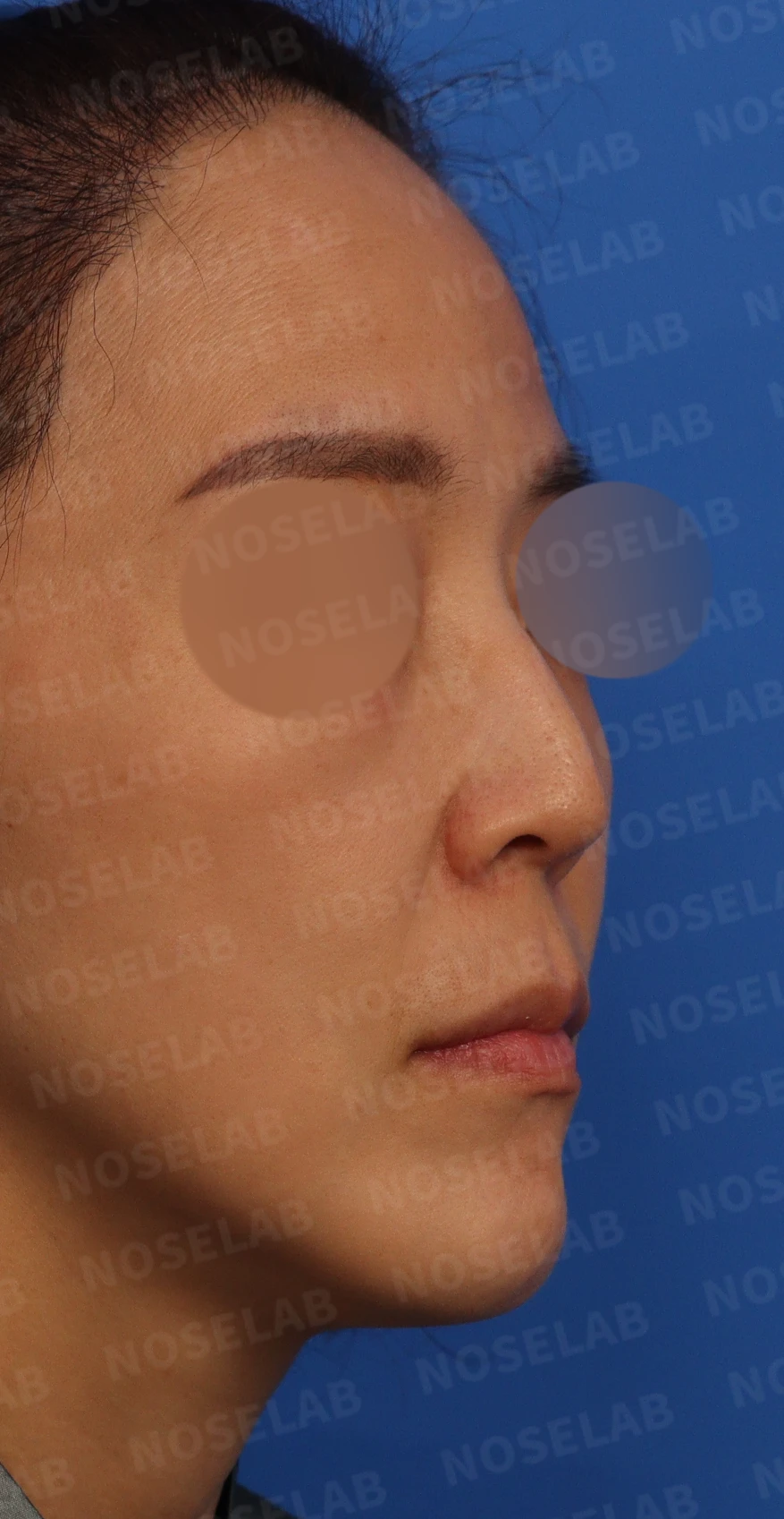 들창코, 매부리코, 휜코까지 한번에 완벽 교정! — 수술전 디자인 상담 우측 측면, 비스듬한 측면, 비공 사진입니다.