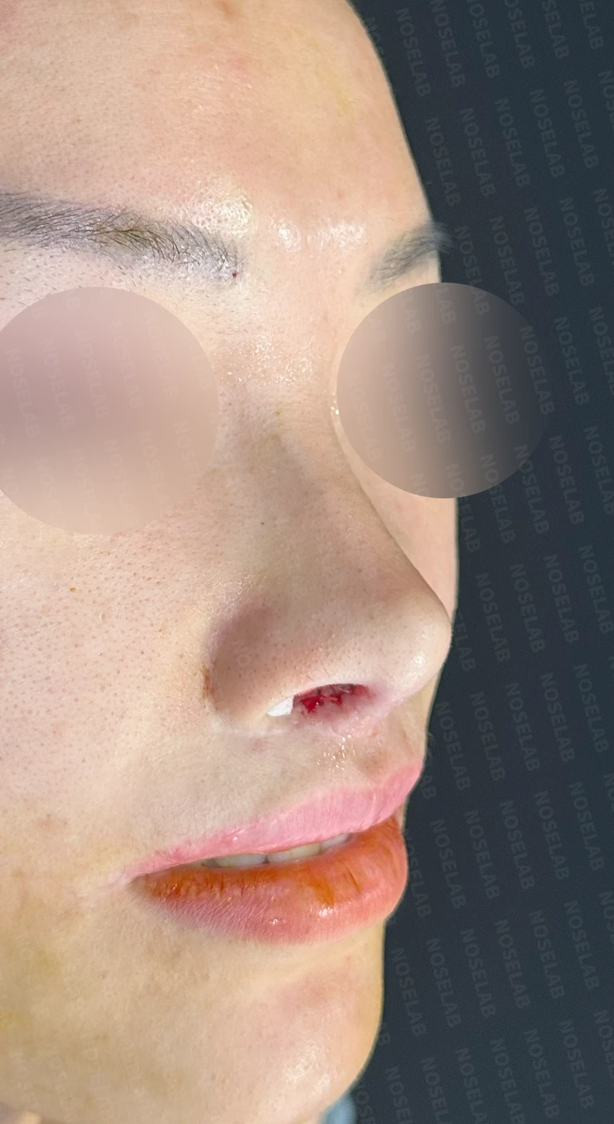 원하는 코 모양과 현재 구조를 함께 살펴보는 수술 계획 — 수술 직후 0일 정면, 측면, 비스듬한 측면 사진 직후 사진은 부기가 있는 상태로 최종 결과와 다를 수 있습니다.