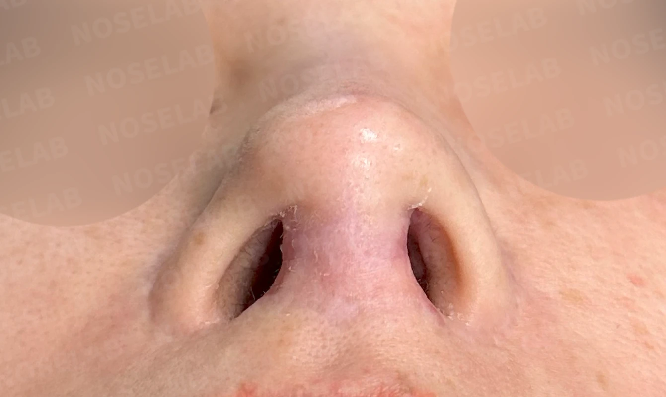 두꺼운 비주와 들린 코끝이 생기는 이유, 자가 늑연골 재건은 어떻게 하나 — 수술 전 / 수술 직후 0일 직후 사진은 부기가 있는 상태로 최종 결과와 다를 수 있습니다.