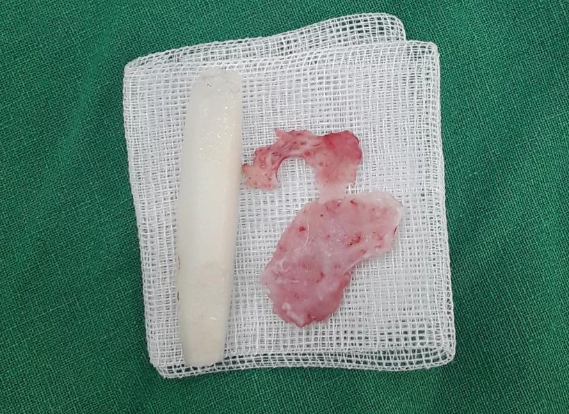 콧볼 축소 뒤 코가 뭉툭하고 길어 보이는 이유, 어떻게 교정하나 — 본문 사진 10