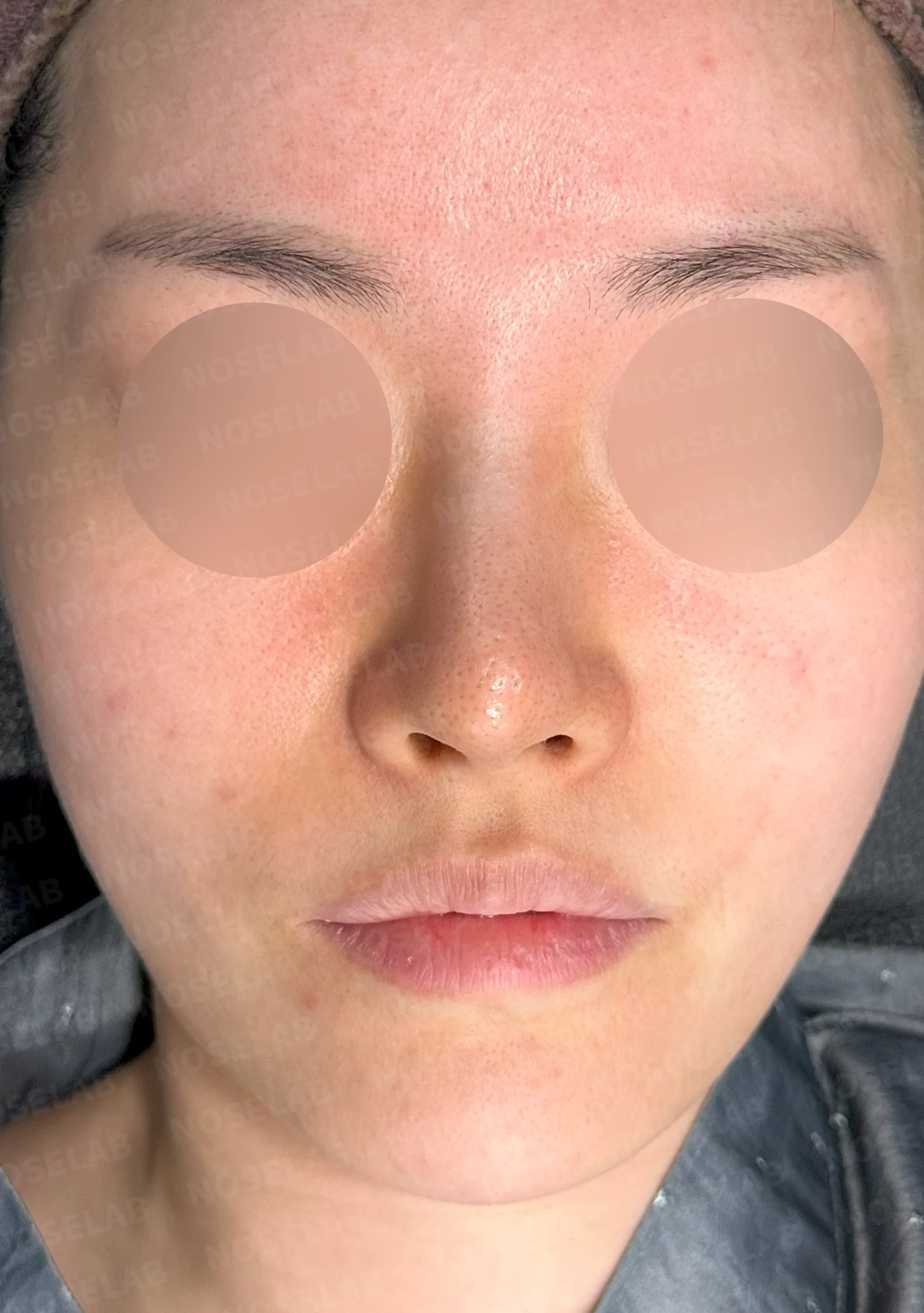 코끝이 비치는 이유와 코끝 포인트를 낮추는 교정 방법 — 본문 사진 10