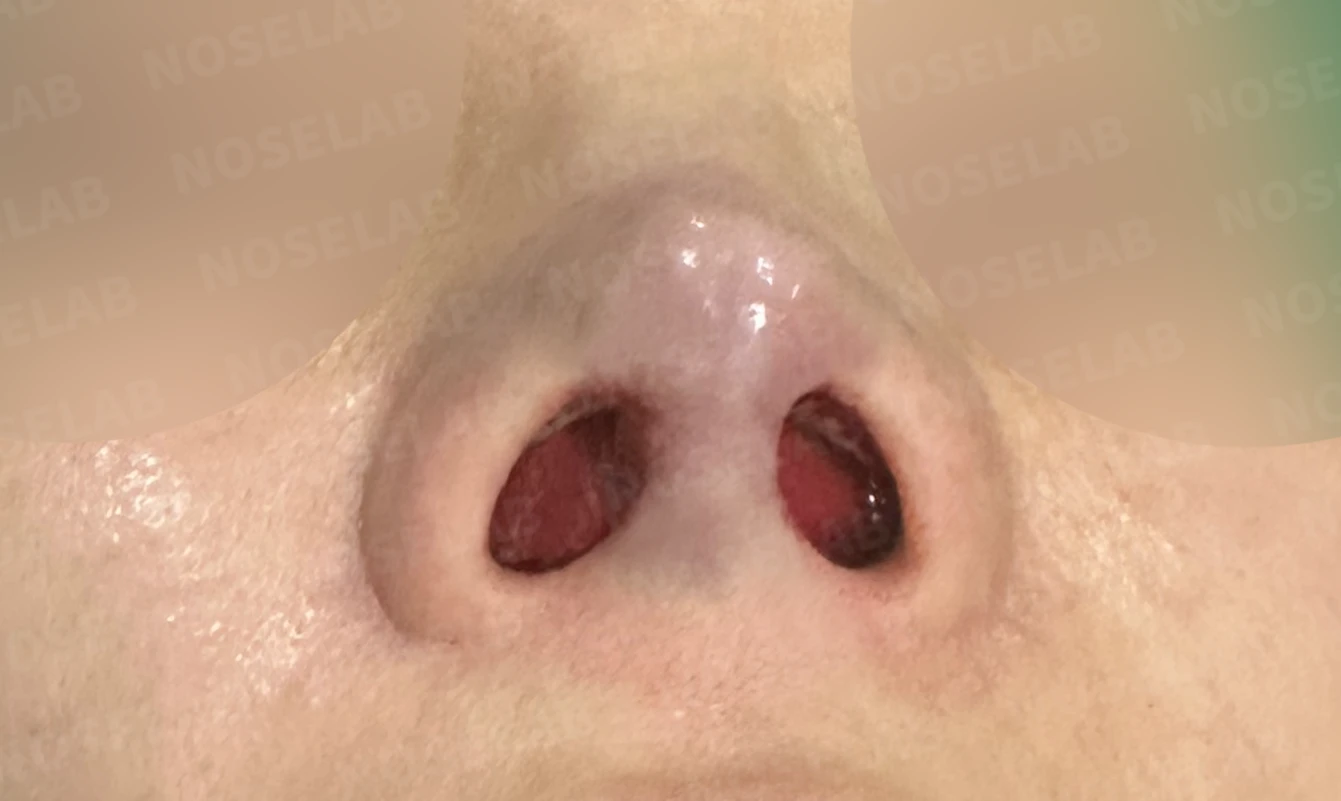 비중격 소실 후 들린 코끝과 찝혀 보이는 콧날개, 자가늑연골로 정밀 재건 — 수술직후 비공 사진입니다.