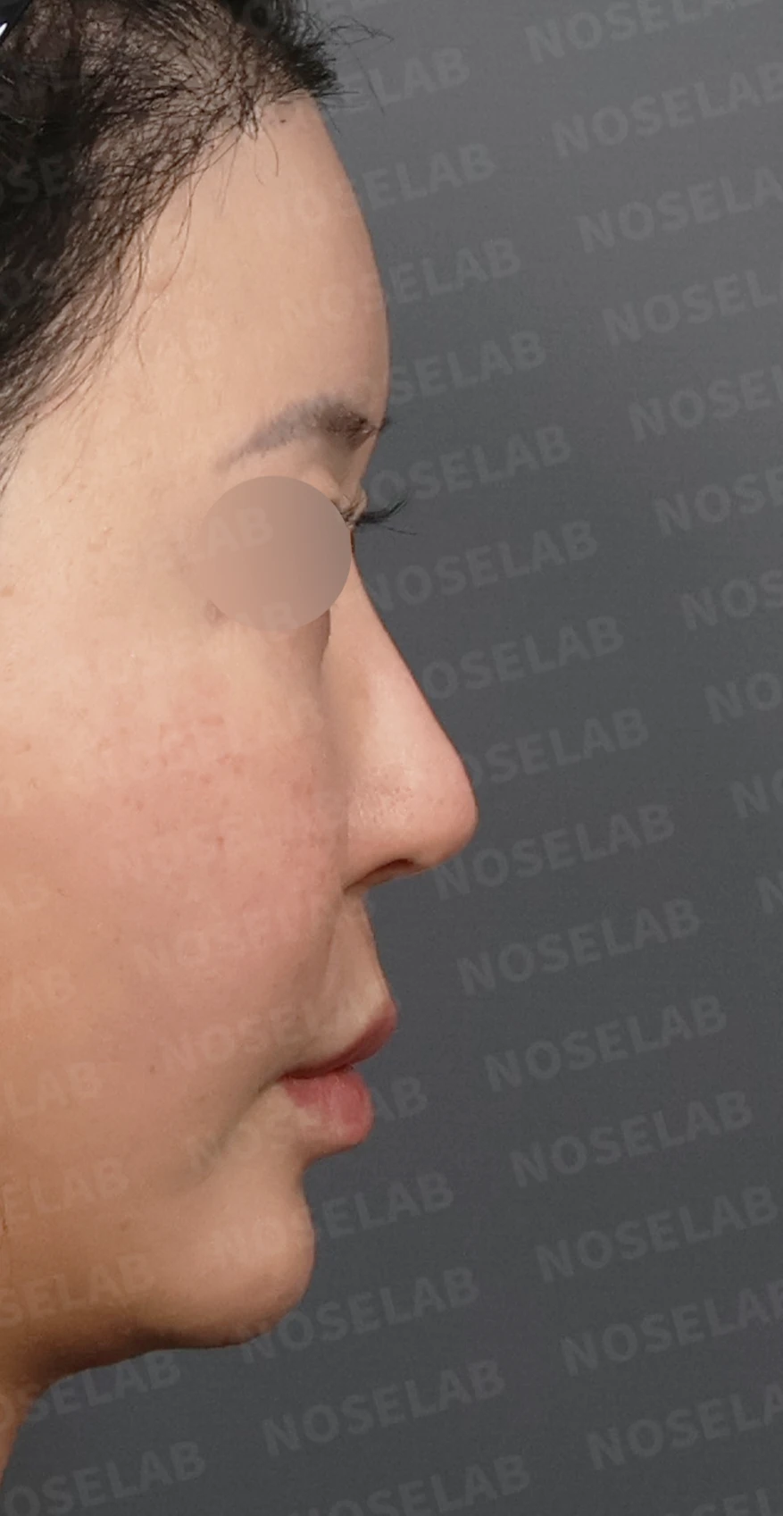코성형 뒤 코막힘이 더 심해지는 이유, 비중격 재건과 절골 복원은 어떻게 하나 — 디자인 상담 우측 측면, 비스듬한 측면, 비공 사진입니다.
