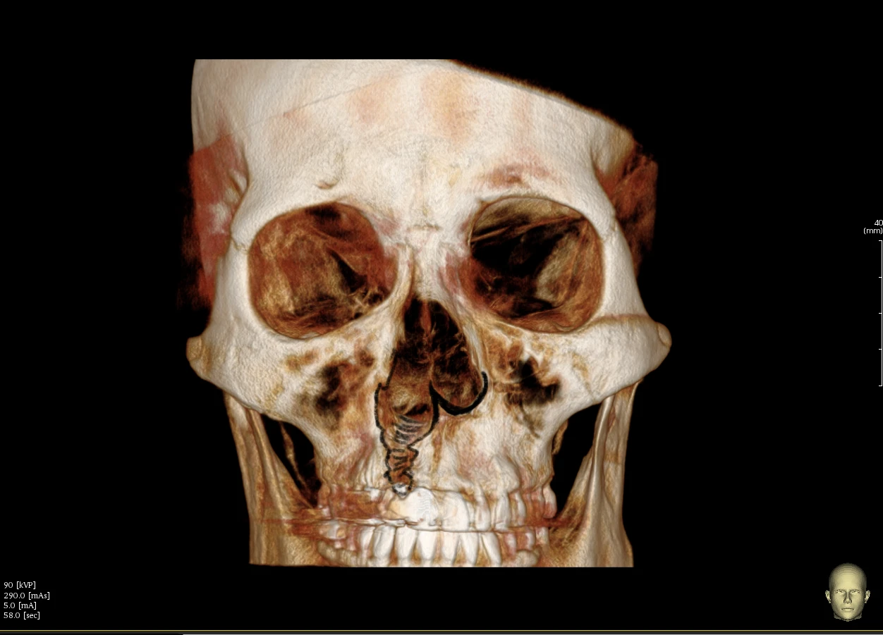 구순구개열에 동반된 코 변형의 교정 방법 — 1.오른쪽 바닥 뼈가 함몰되어 있는 사진 2. 자가늑연골을 이용하여 채워줄 예상도입니다.