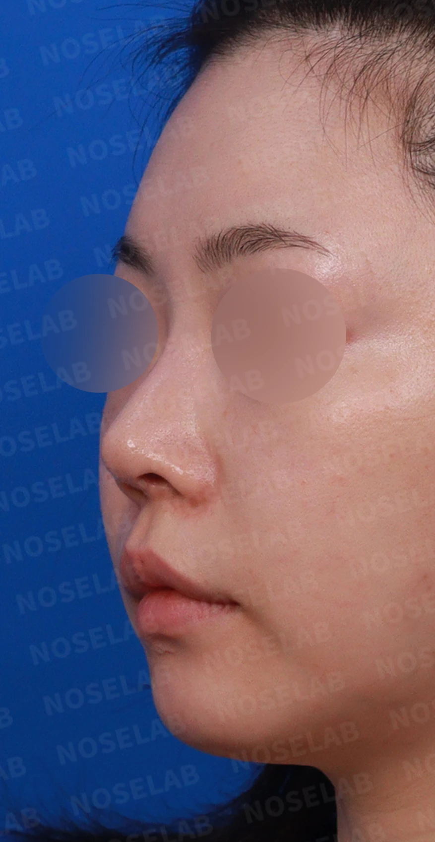 비중격 연골을 과도하게 채취하면 생기는 문제와 재건 방법 — 디자인 상담 정면, 좌측, 비스듬한 측면 사진입니다.