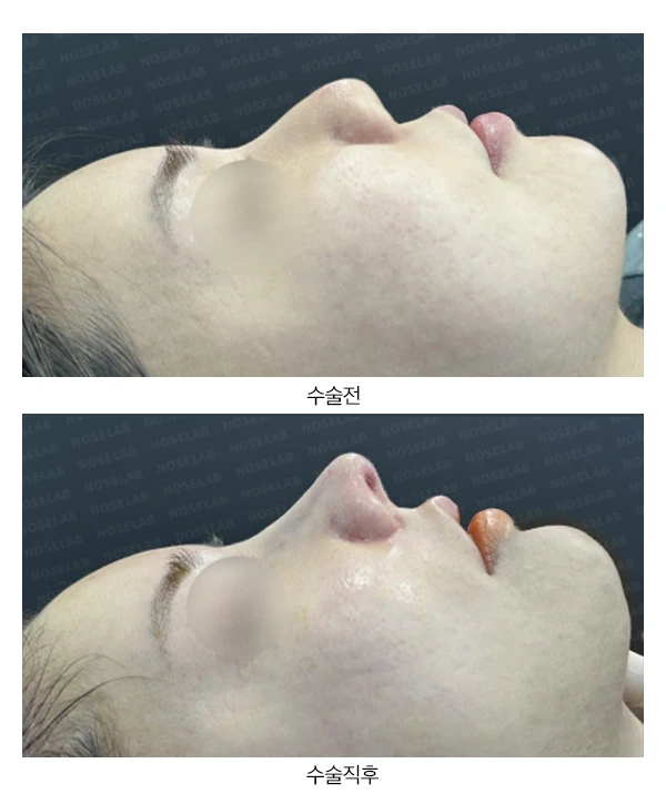 복코 교정과 비주 내리기 방법 — 본문 사진 17
