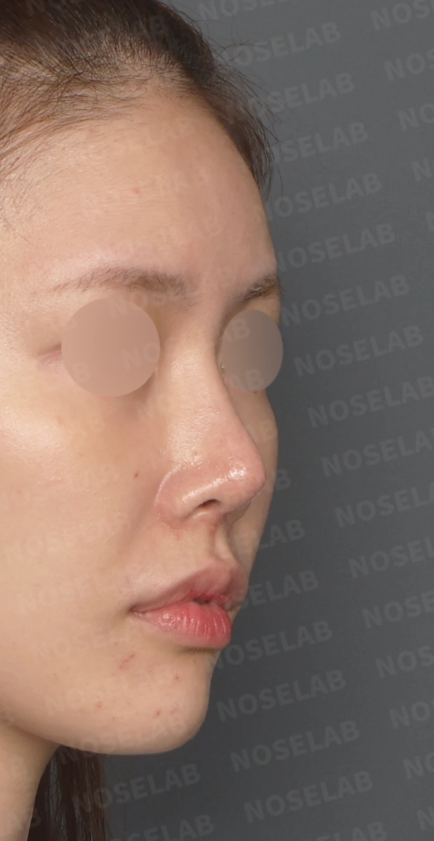 보형물 비침과 비대칭, 자가늑연골 코재수술로 자연스럽게 교정한 사례 — 디자인 상담 우측 측면, 비스듬한 측면, 비공 사진