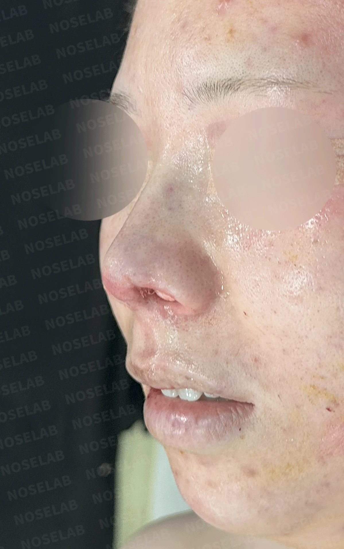 콧구멍을 막는 종괴가 생기는 이유, 제거와 재건은 어떻게 하나 — 본문 사진 20