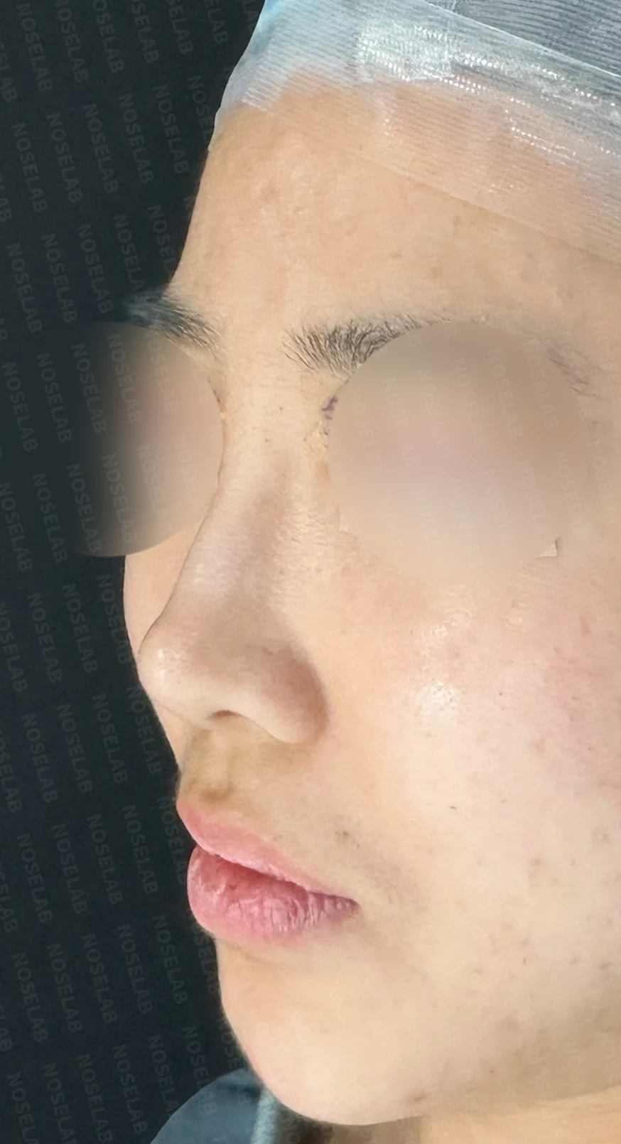 코필러 제거, 코막힘 해결 사례 — 전(좌) 직후(우)
