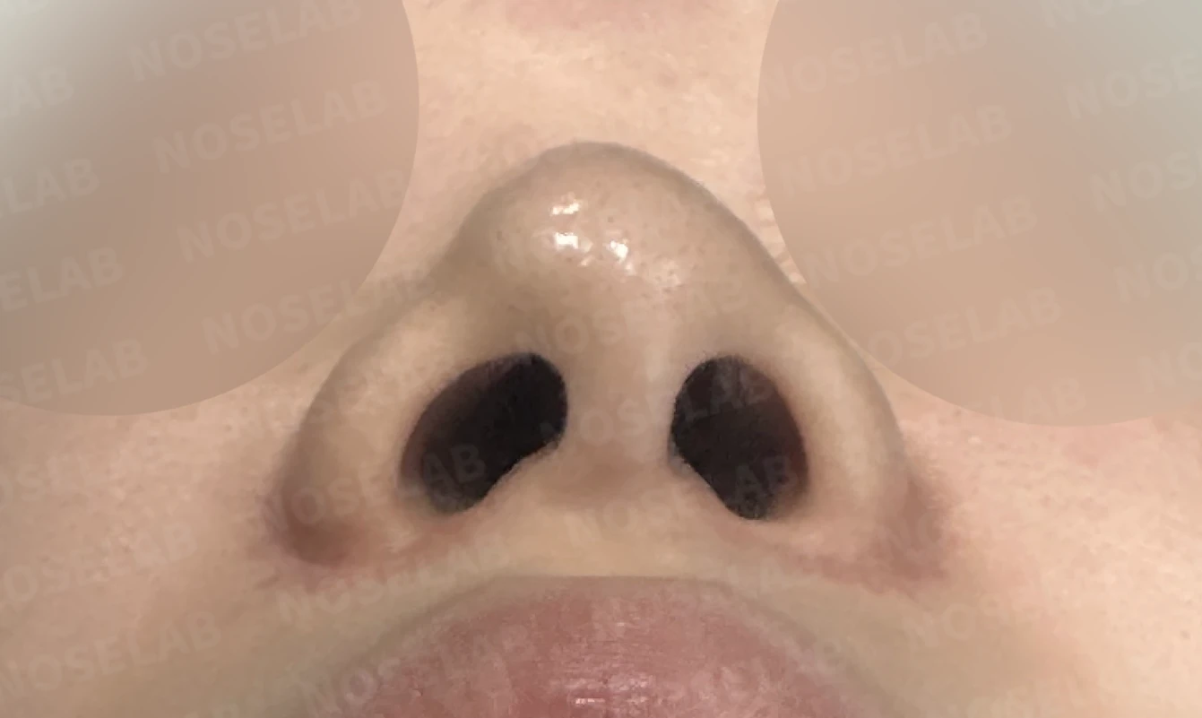 절골 부위가 과하게 깎이면 코가 왜 휘어 보이는가, 코뼈 복원과 코끝 재건 — 수술 전 / 수술 직후 0일 직후 사진은 부기가 있는 상태로 최종 결과와 다를 수 있습니다.