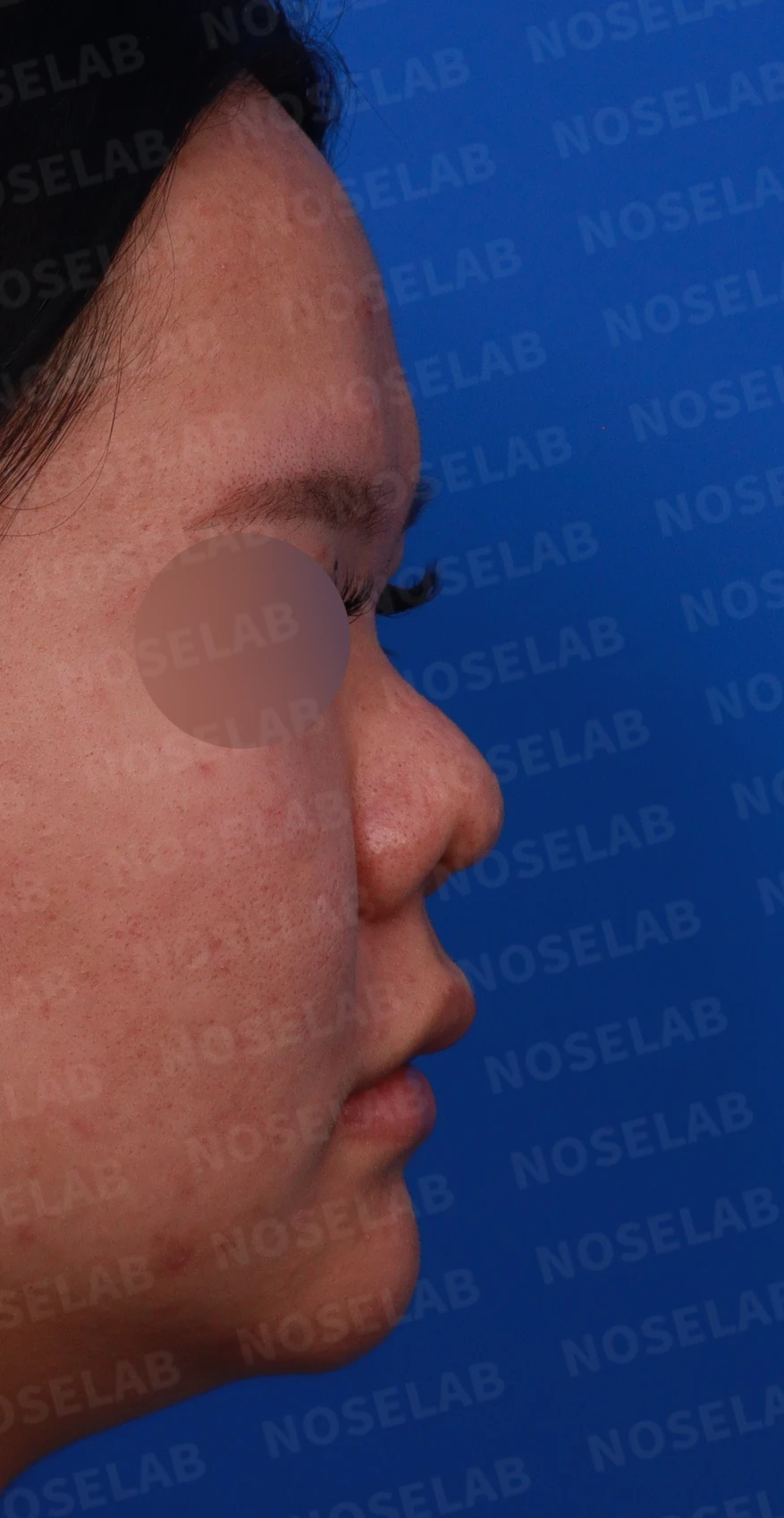복코와 짧은 코, 비주 함몰이 함께 나타나는 이유와 코끝 입체감을 만드는 방법 — 디자인 상담 우측 비스듬한 측면, 측면, 비공 사진
