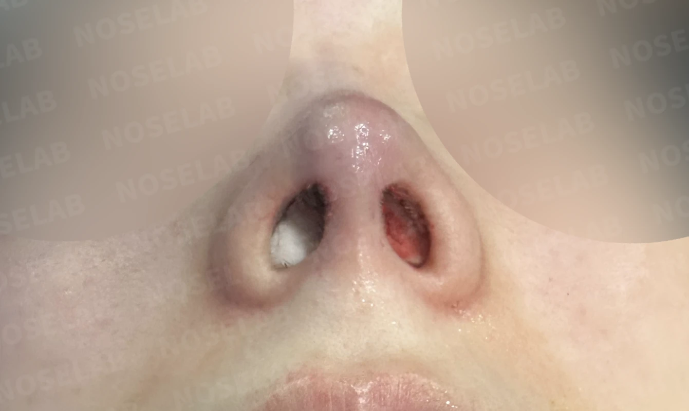 작고 낮은 코, 자가늑연골로 비순각 교정까지 한 번에 완성한 비개방 코성형 — 전(좌) 직후(후)