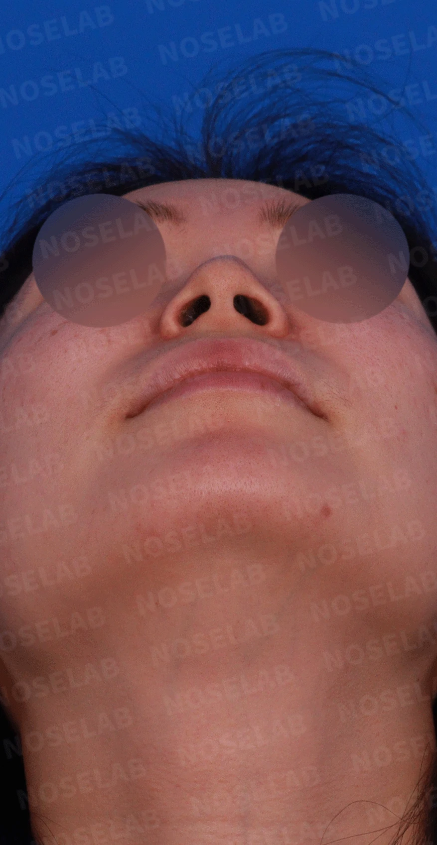 매부리코와 휜 코에 코막힘이 함께 오는 이유, 복합 교정은 어떻게 하나 — 디자인 비스듬한 측면, 측면, 비공 사진입니다.