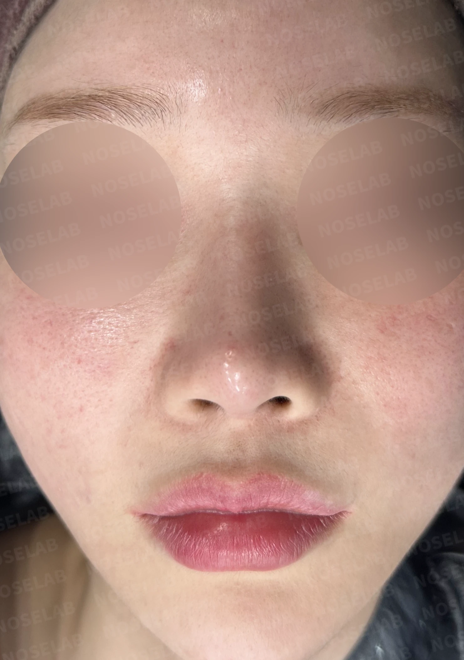 여러 차례 코수술 후 자가늑연골과 자가진피로 코 전체를 자연스럽게 높인 재수술 — 전(좌) 직후(후)