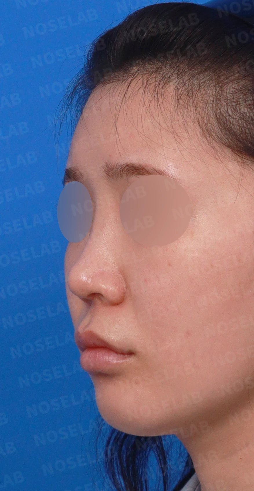 연골 노출 복원과 날개 연골 재건으로 안전하고 자연스러운 코 — 디자인 상담 정면, 좌측 측면, 비스듬한 측면 사진입니다.