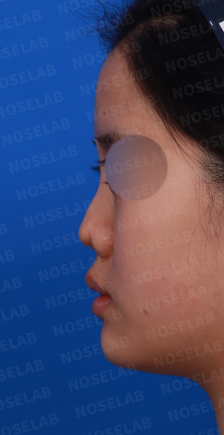 이전 수술 뒤 콧구멍이 좁아지는 비공협착, 원인과 재건 방법 — 디자인 상담 정면, 좌측 측면, 비스듬한 측면 사진입니다.
