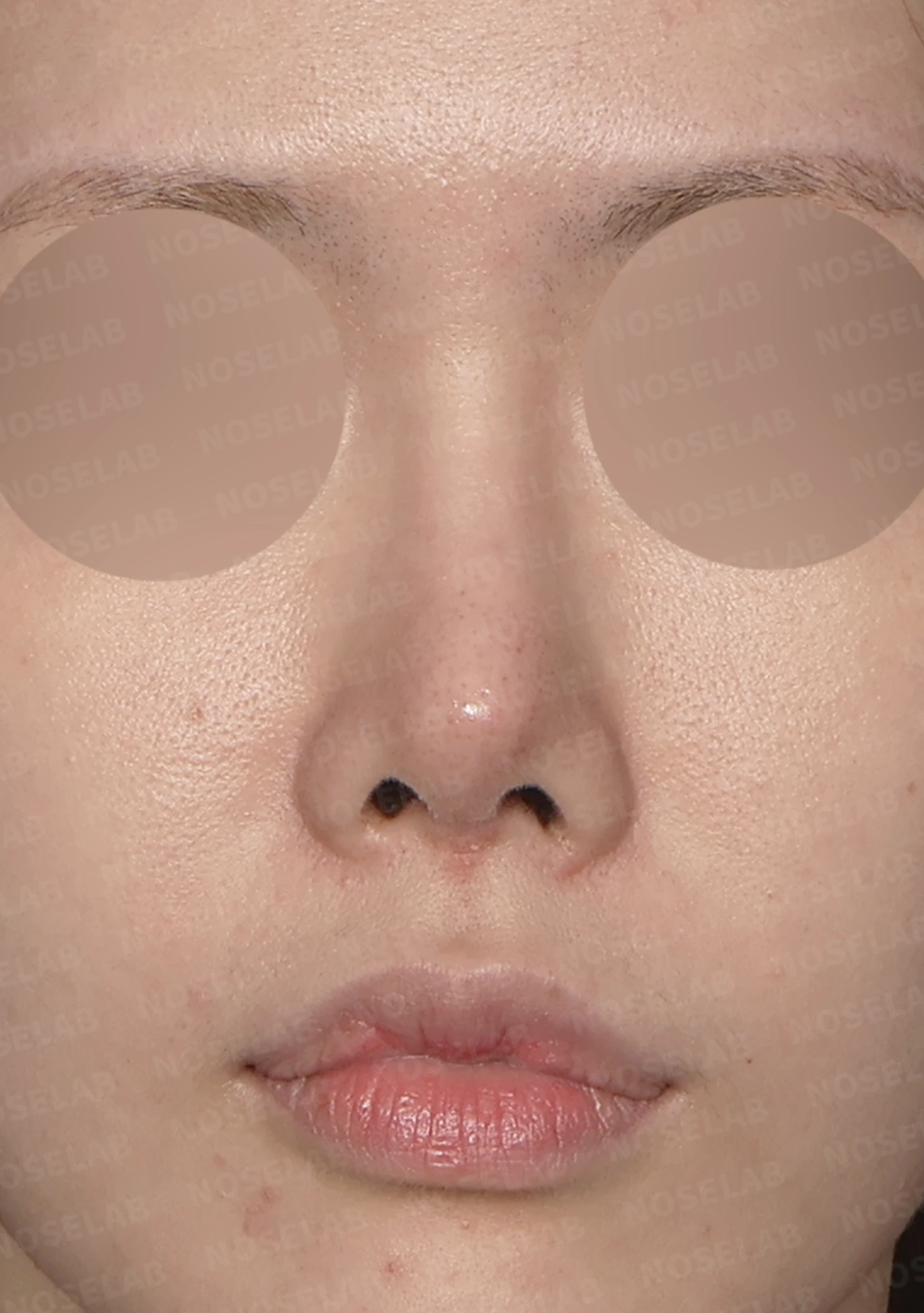 보형물 비침과 비대칭, 자가늑연골 코재수술로 자연스럽게 교정한 사례 — 전(좌) 직후(후)