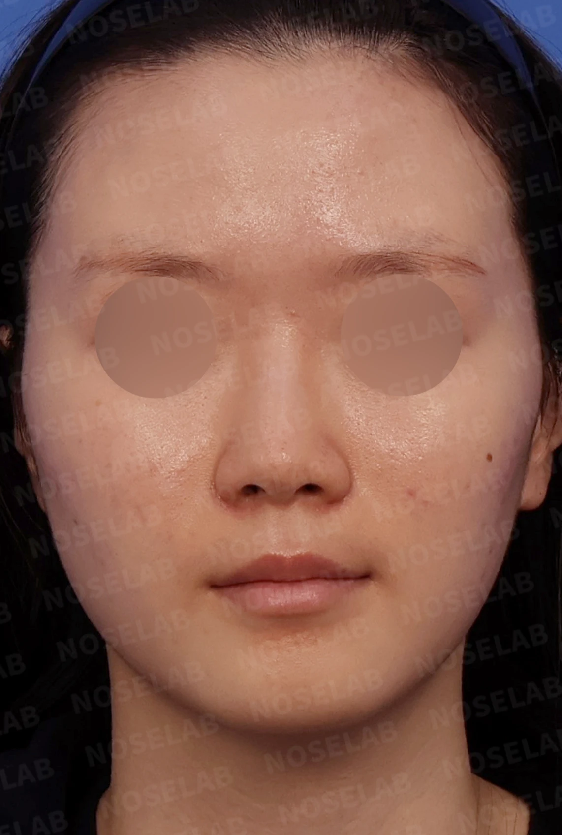 콧대가 퍼져 보이고 코끝이 뭉툭한 이유, 절골술과 자가 늑연골 교정은 어떻게 하나 — 디자인 상담 정면, 좌측 측면, 비스듬한 측면 사진입니다.